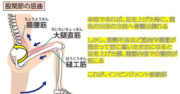 本来であれば、足を上げた時に、黄色の矢印の方向へ骨盤は倒れる しかし、姿勢不良など筋肉や関節が固まって前に傾いたままになると 足を上げた際、関節内部での衝突が起こる これが、インピンジメント症候群