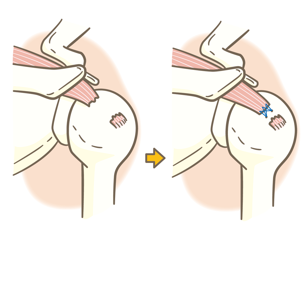 肩腱板断裂の縫合術式のイラスト